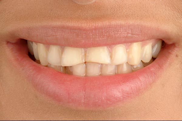 Paciente antes de ponerle carillas dentales en nuestra clínica dental de Valladolid
