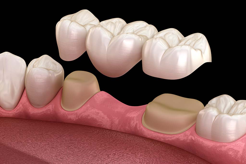 Ejemplo tratamiento, poner diente sin implantes con puente dental