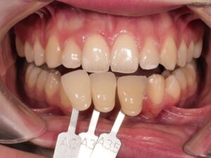 casp clínico blanqueamiento dental valladolid