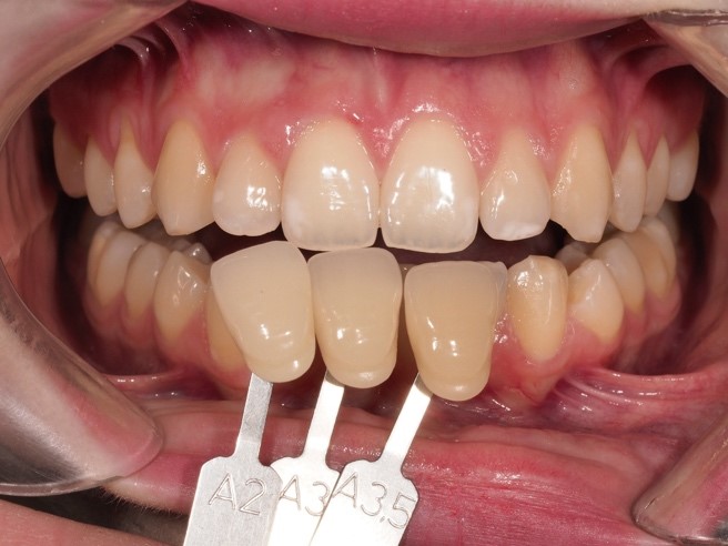 caso clínico blanqueamiento dental valladolid