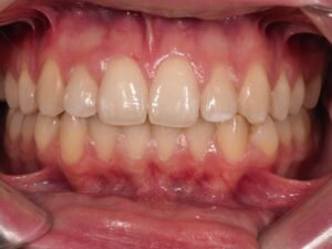 caso clínico blanqueamiento dental valladolid