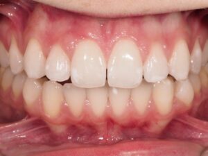 caso clínico blanqueamiento dental valladolid