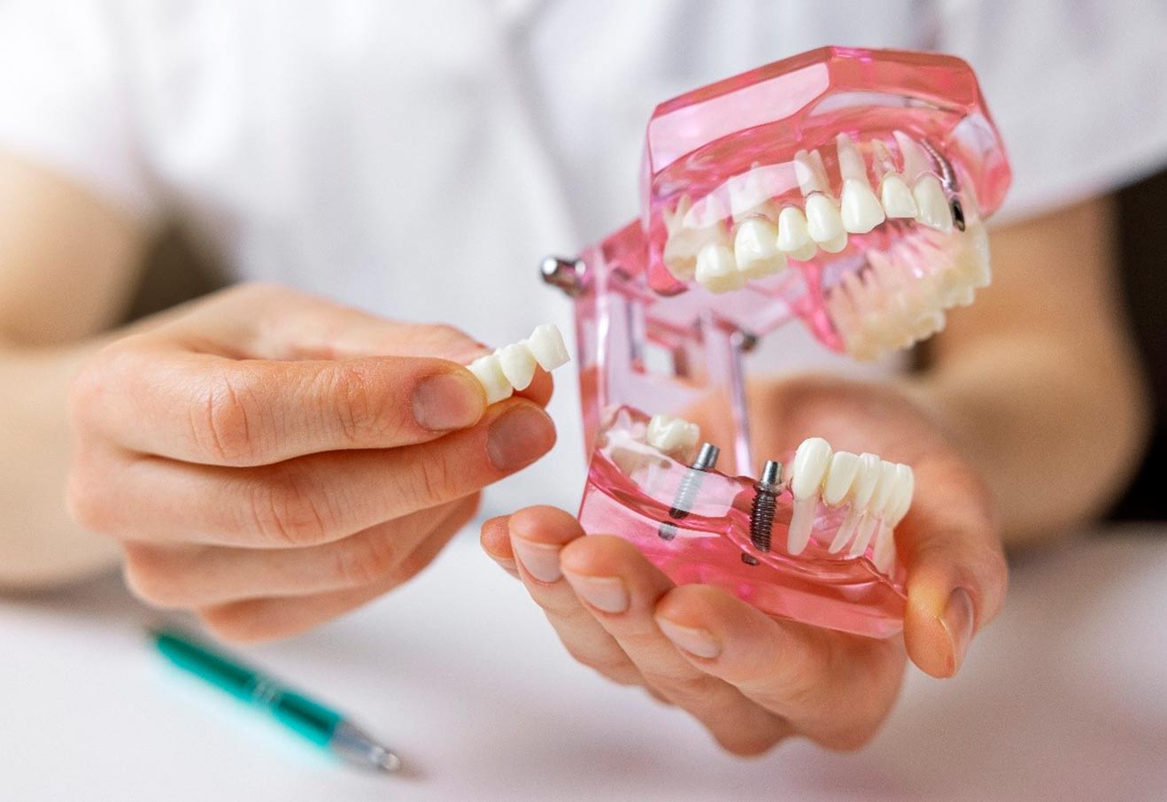 poner implantes dentales en javier sola
