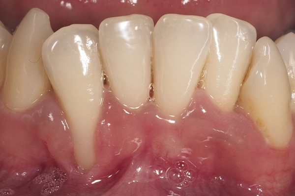 Caso clínico periodoncia - antes