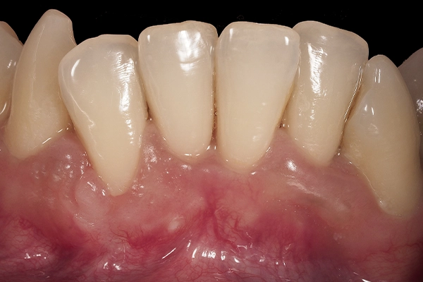 Caso clínico periodoncia - después
