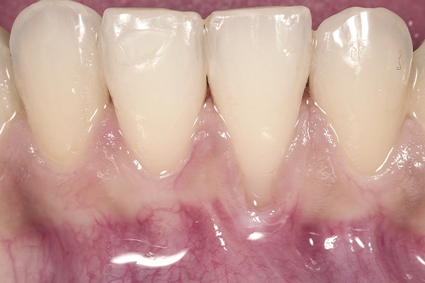 Caso clínico periodoncia - antes