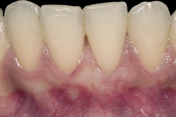 Caso clínico periodoncia - después