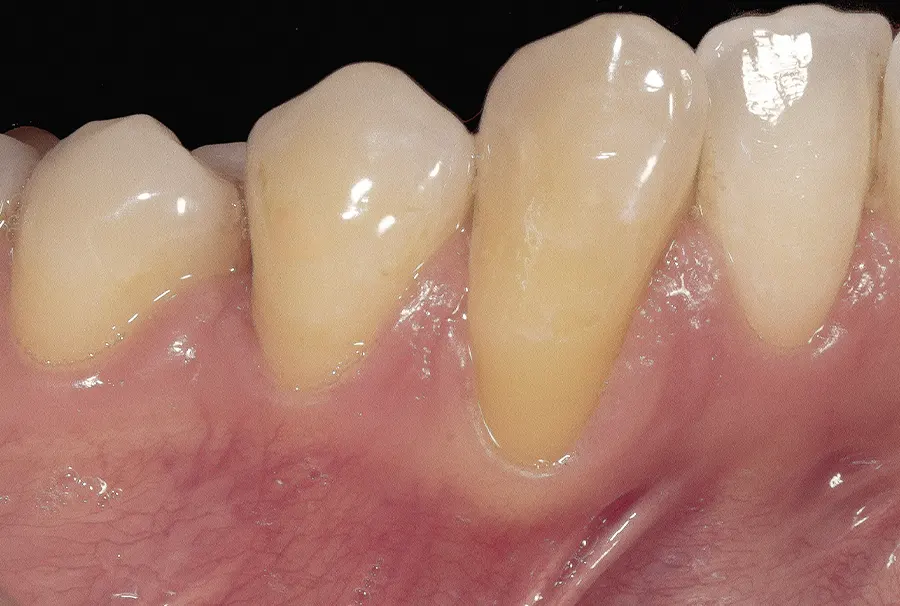 Caso de recesión gingival - Antes