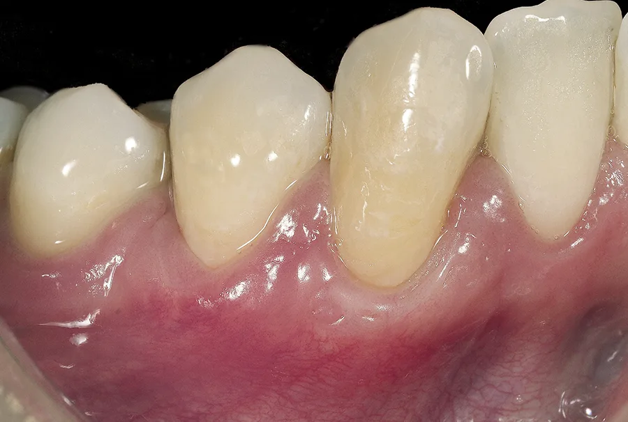 Caso de recesión gingival - Después