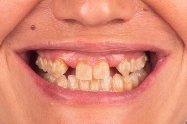 Caso clínico 1.1 antes