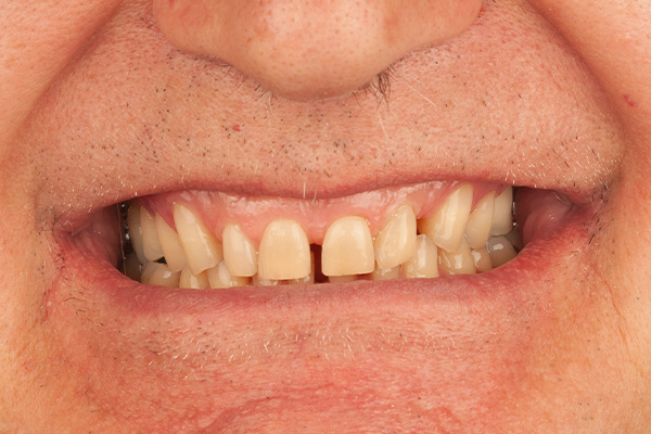 Caso clínico 3.1 antes