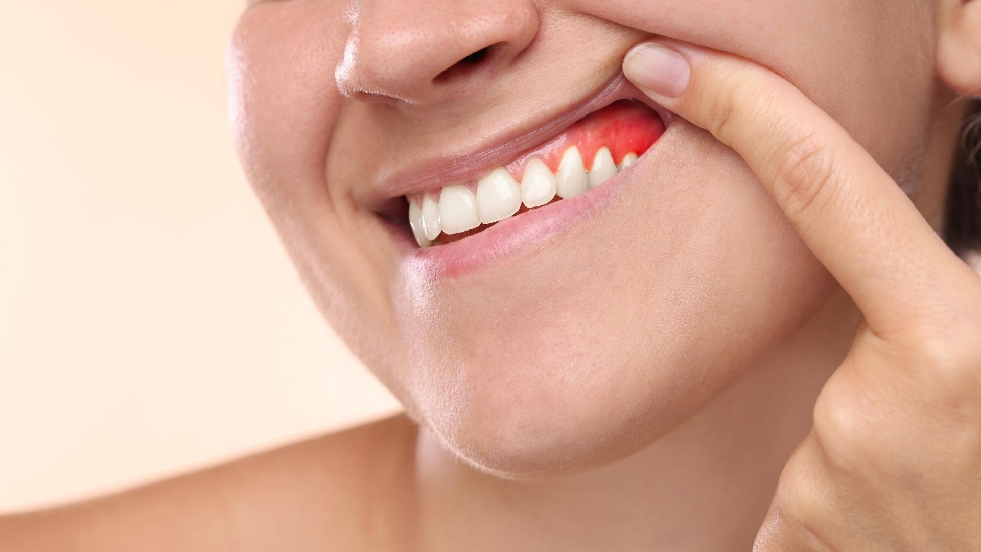 Una persona enseñando sus encías enrojecidas