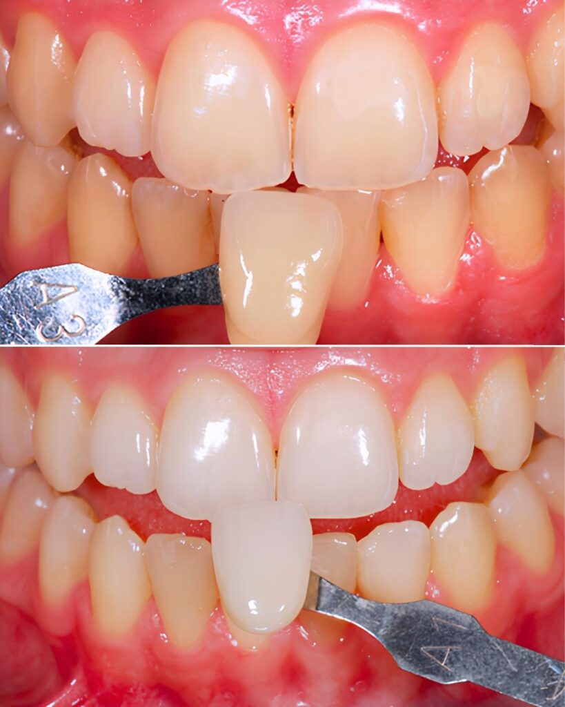 Caso clínico de blanqueamiento dental